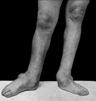 Fig. 164.—Charcot's Disease of both Ankles: front view. Man, æt. 32.